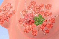 乳腺癌脊柱转移 广州中医药大学金沙洲医院智慧精准放疗开辟康复之路