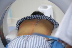 肿瘤微创介入治疗