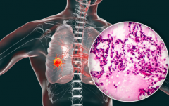 肺癌患者要如何做好术后护理？肿瘤专家胡群峰教授给出了答案 